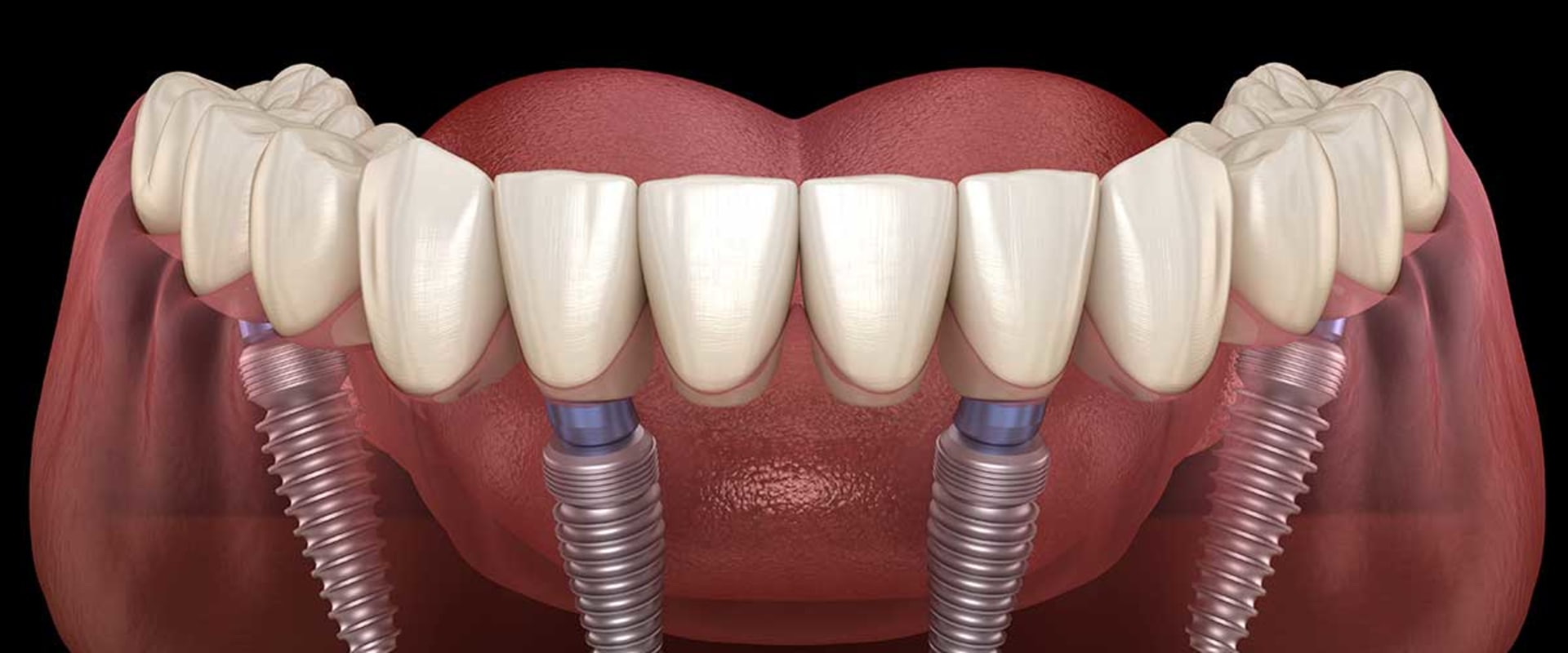 Preserving Jaw Bone: How to Maintain a Strong Foundation for Implant-Supported Dentures